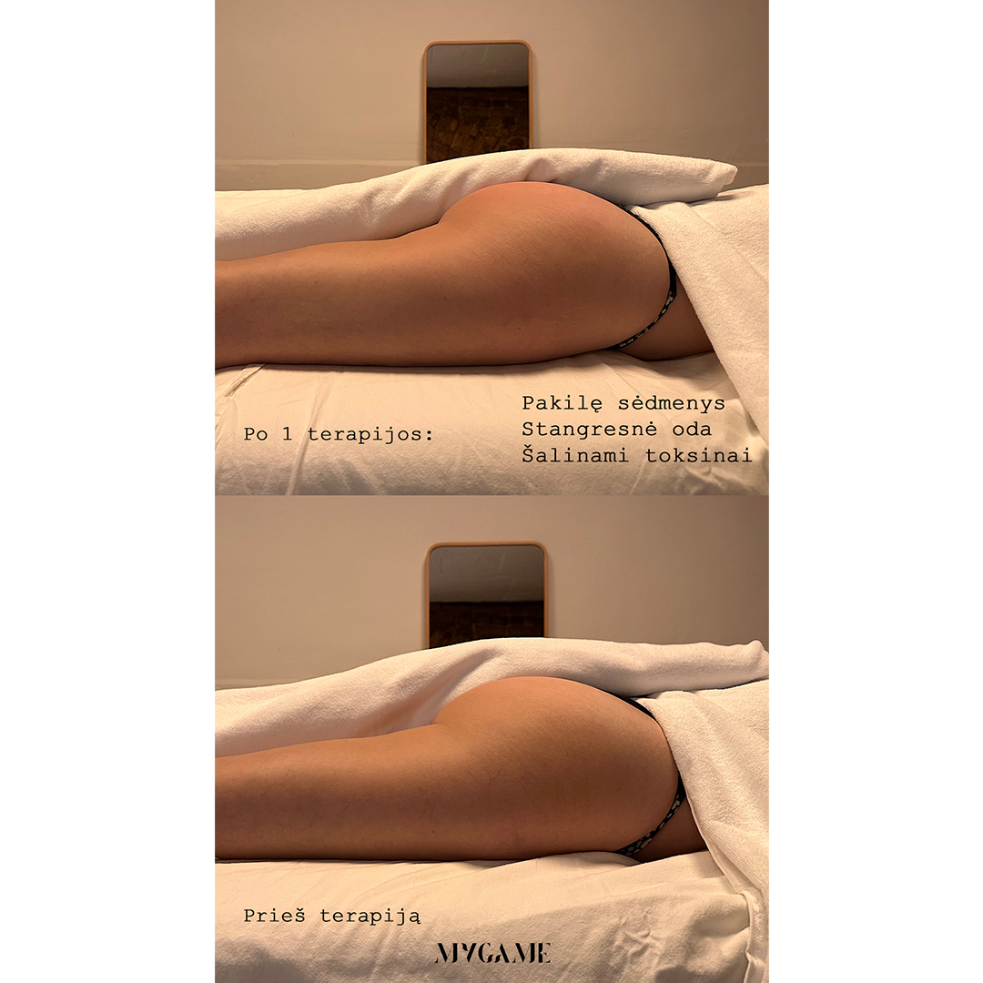 ENDOSPHERES KŪNO TERAPIJŲ ABONEMENTAS  (12VNT.)