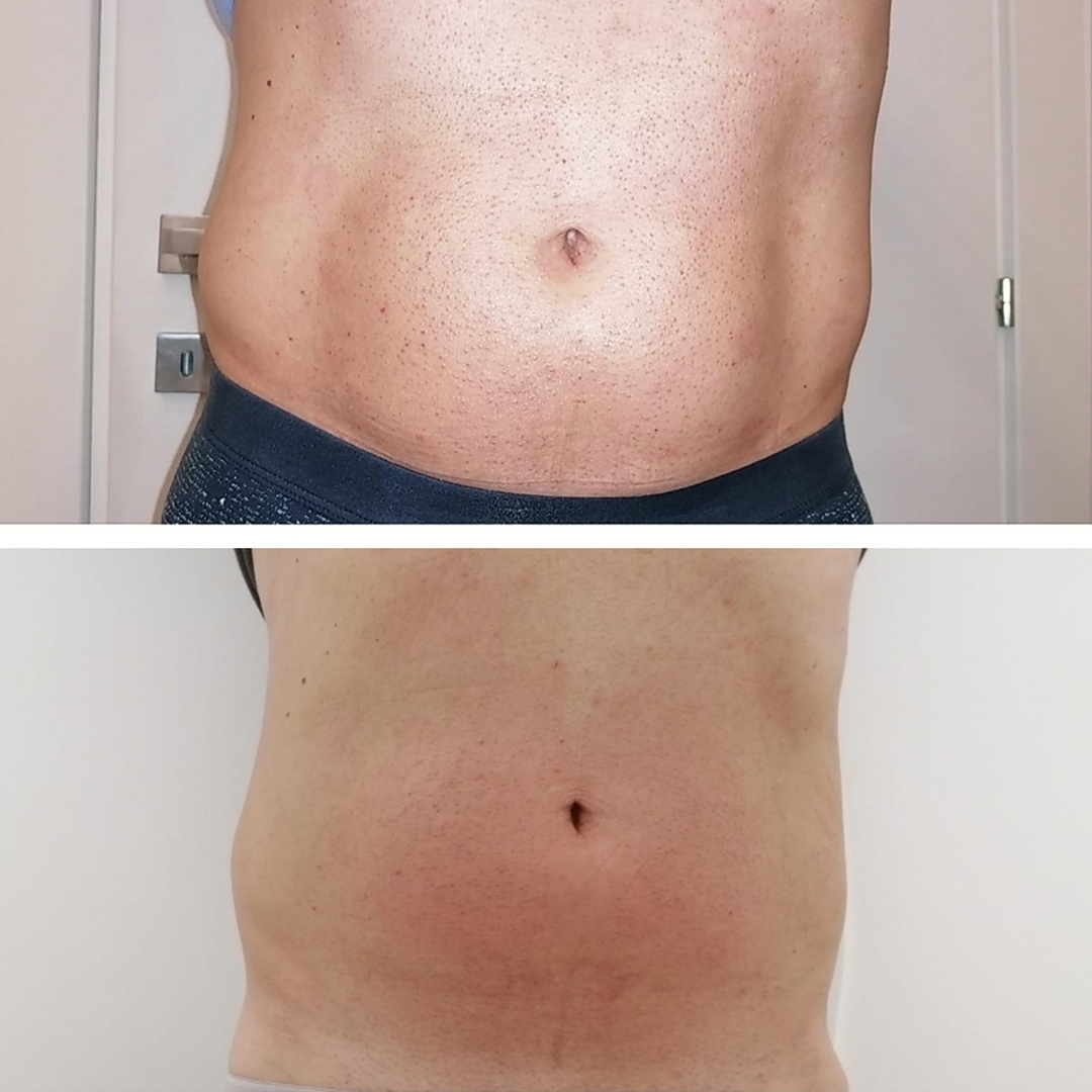 ENDOSPHERES KŪNO TERAPIJŲ ABONEMENTAS  (12VNT.)