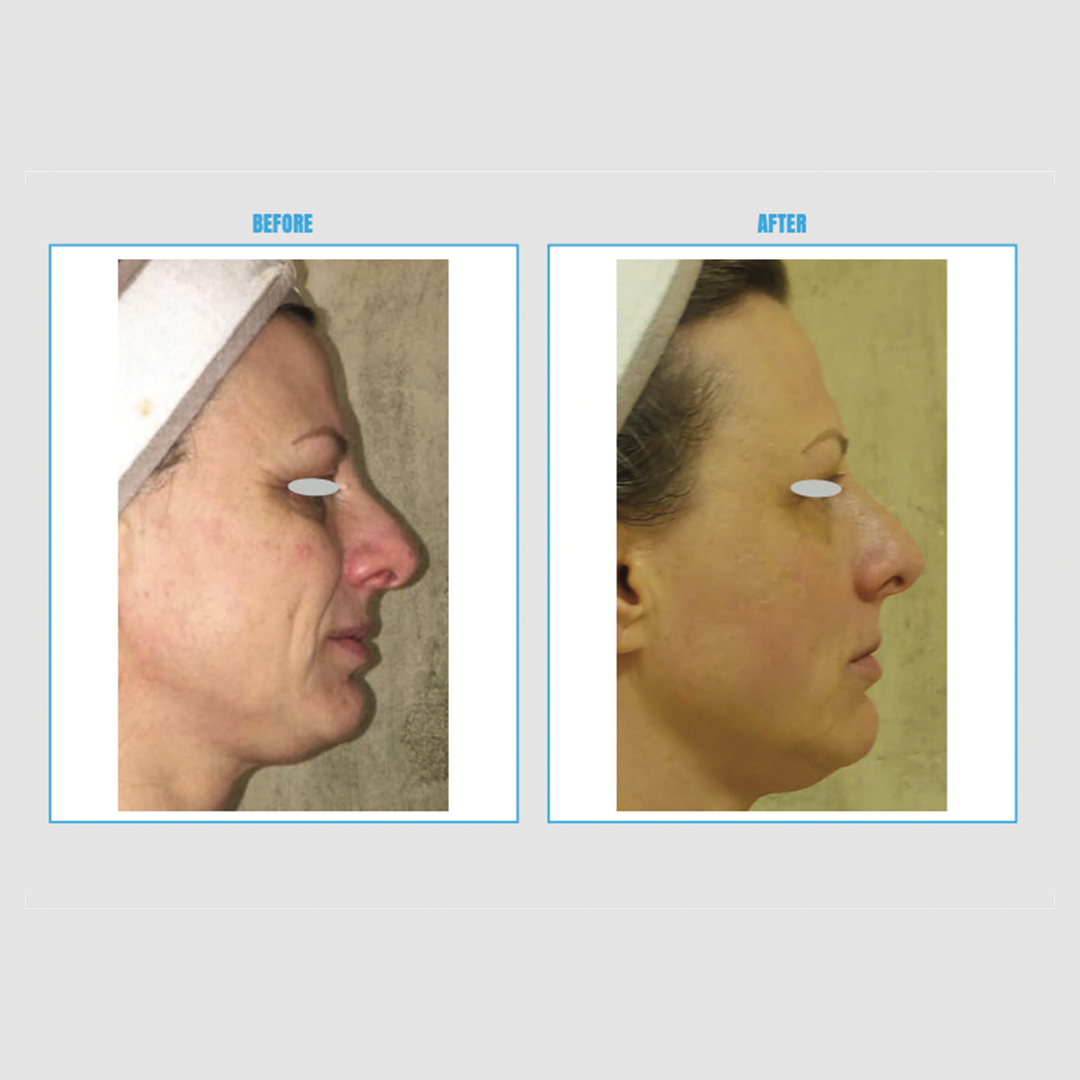 ENDOSPHERES VEIDO, KAKLO, DEKOLTĖ TERAPIJOS (6vnt.)