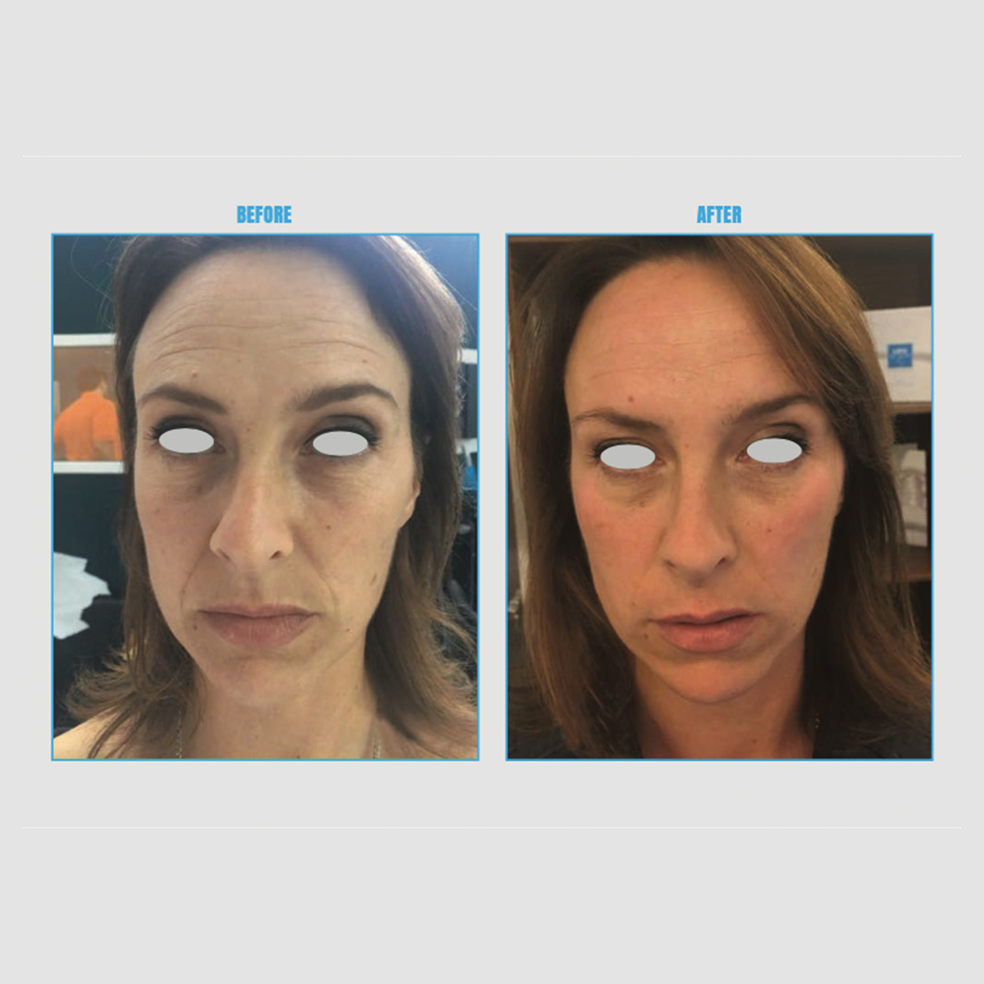 ENDOSPHERES VEIDO, KAKLO, DEKOLTĖ TERAPIJOS (6vnt.)