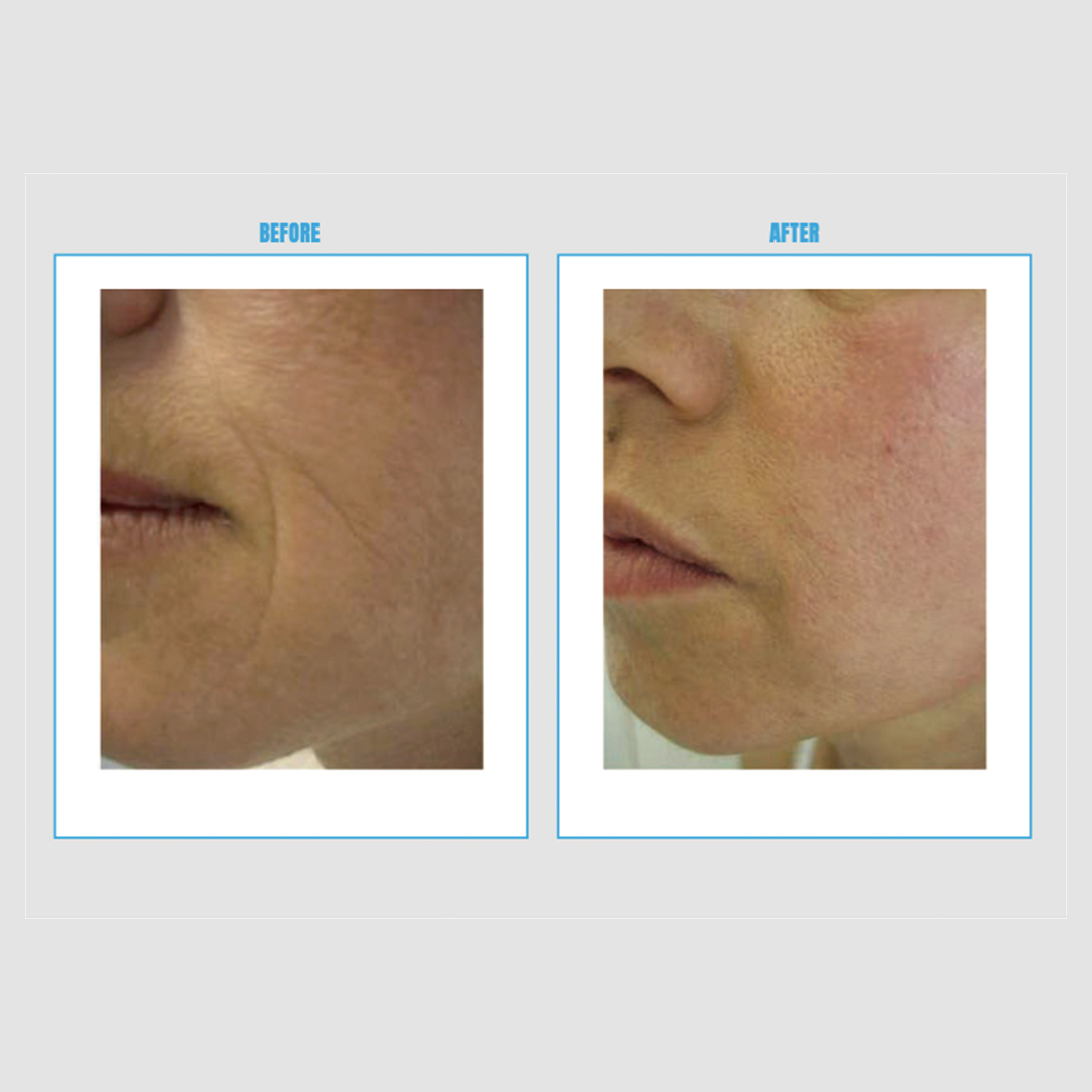 ENDOSPHERES VEIDO, KAKLO, DEKOLTĖ TERAPIJOS (6vnt.)